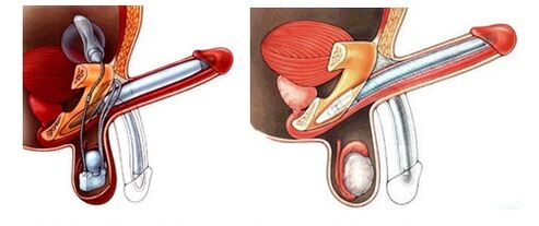 Penile prosthesis with inflatable prosthesis (left) and plastic (right)