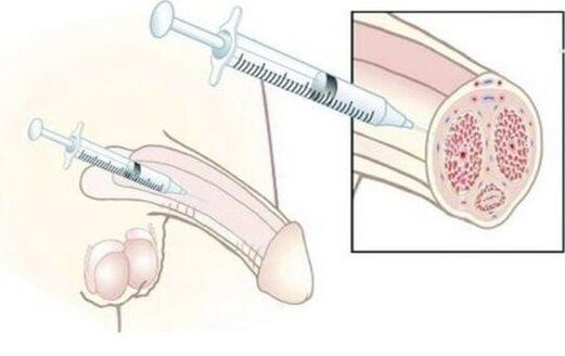 Injection of hyaluronic acid