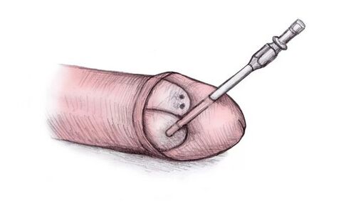 The glans penis can be enlarged with hyaluronic acid gel injections