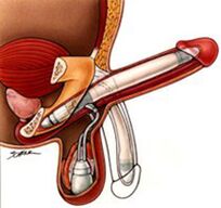 Male penis enlargement implants